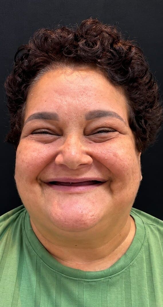 Antes: sorriso de uma paciente com prótese dentária na Clínica Vita Implantes