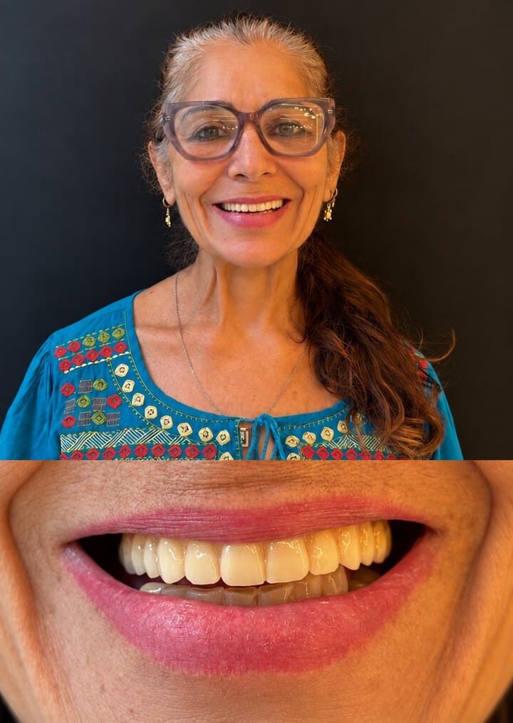 Depois: sorriso de uma paciente com protocolo sobre implantes na Clínica Vita Implantes