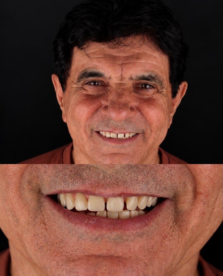 Antes: sorriso de um paciente com lentes de contato dental na Clínica Vita Implantes