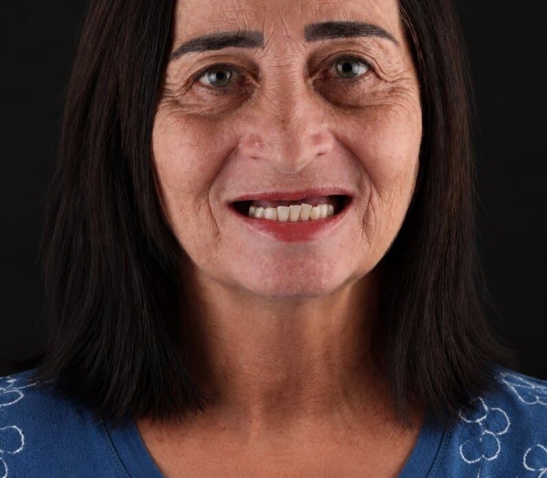 Antes: sorriso de uma paciente com prótese dentária na Clínica Vita Implantes