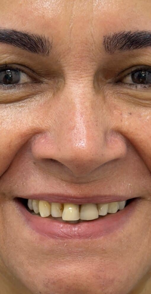 Antes: sorriso de uma paciente com lentes de contato dental na Clínica Vita Implantes
