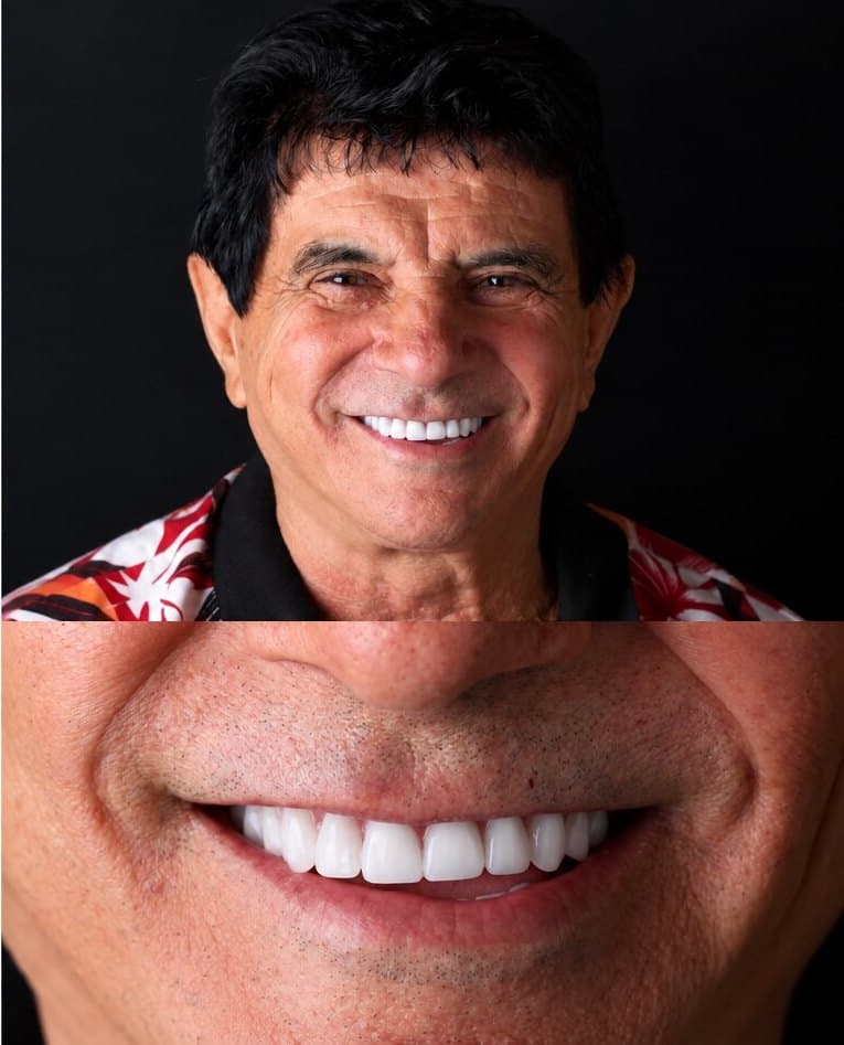 Depois: sorriso de um paciente com lentes de contato dental na Clínica Vita Implantes