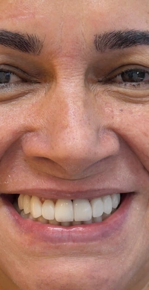 Depois: sorriso de uma paciente com lentes de contato dental na Clínica Vita Implantes