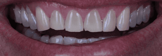 Antes: sorriso de paciente de lentes de contato dental da Clínica Vita Implantes